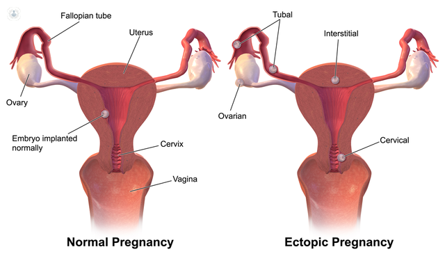 الفرق بين الحمل خارج الرحم والحمل الطبيعي